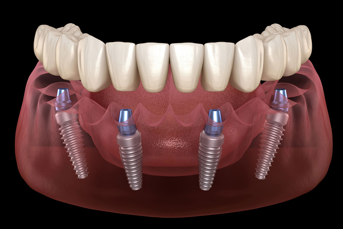 3D model showing dental implants being placed