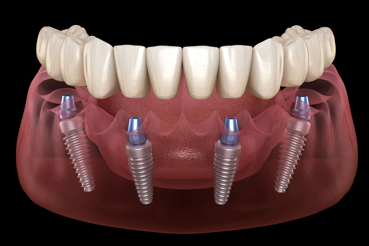 3D model showing dental implants being placed