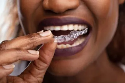 woman putting in her new clear aligners