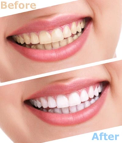 professional teeth whitening in Tacoma, WA